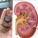 Illustration for article titled obat penghancur batu ginjal alamiem/em